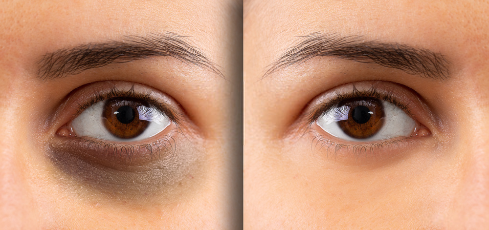 How to get rid of Dark Circles under eyes